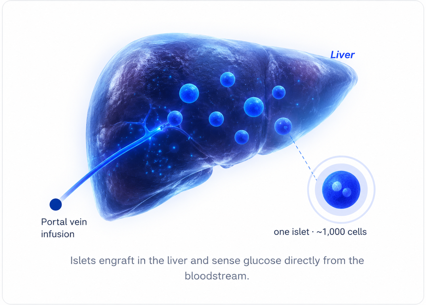 Islets engrafting in the liver via portal vein infusion